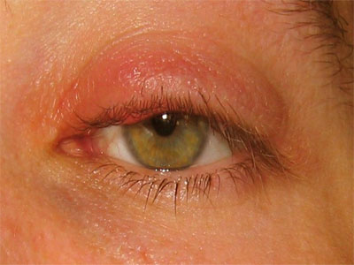 Blepharitis