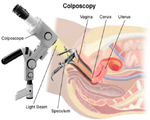 Colposcopy