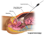 Laparoscopy