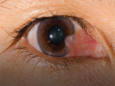 Pterygium